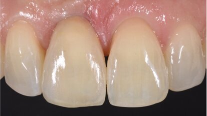 Digital dental shade measurement: Practical applications with a state-of-the-art colorimeter