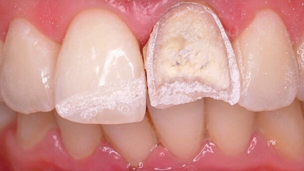 Laser Er:YAG et élimination des résines composites