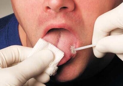 OralCDx2: Enhanced diagnostic test for oral dysplasia and cancer