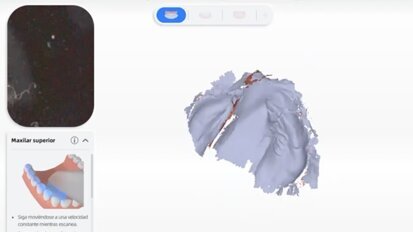 Labio y paladar fisurado Luna Video4