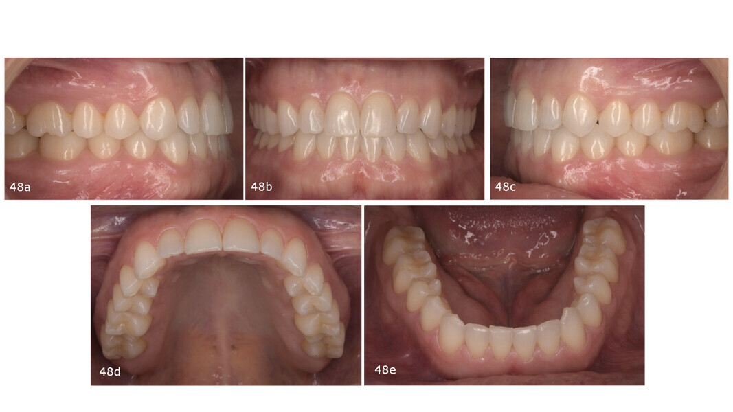 Figs. 48a–e: Post-treatment intra-oral photographs.