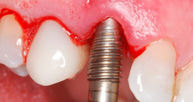 Άμεση τοποθέτηση εμφυτεύματος με οστεοτόμους Paltop για οστική διεύρυνση