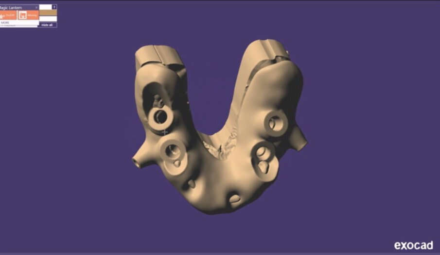 Figg. 21-25_Progettazione Cad con exocad.