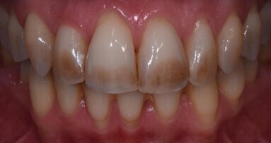 Incompetenza labiale e macchie  sui denti una relazione possibile