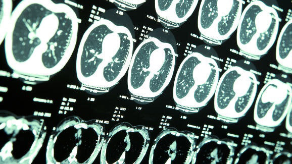 Dentale röntgenfoto’s verhogen risico op goedaardige tumor
