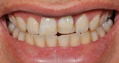 Trattamento biomimetico grazie a una scala colori intelligente modificabile in un caso post-trauma