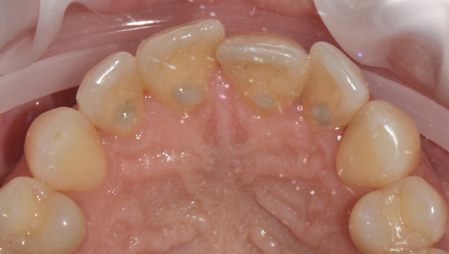 Figg. 4a-4f - Confronto fra inizio e termine della terapia. Le immagini (4a-c) mostrano le aree vestibolare palatale e linguale prima della terapia, mentre le immagini (4d-f) mostrano le aree vestibolare palatale e linguale dopo della terapia.