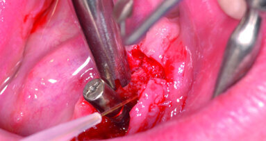 The TwinLight approach to peri- implantitis