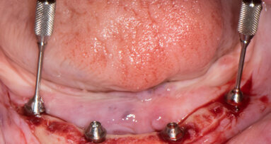 Straumann Pro Arch concept with fully guided implant and abutment placement