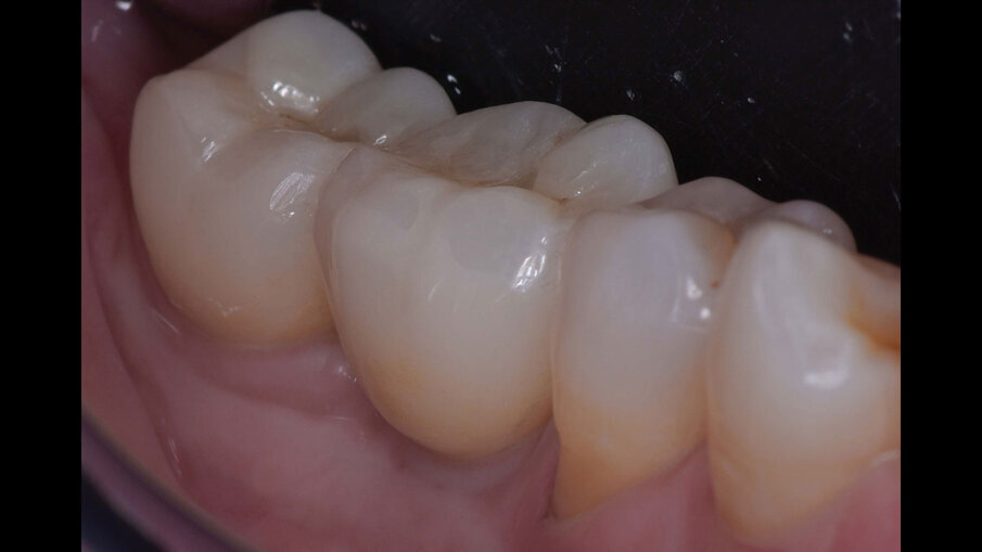 Figg. 20a, 20b_Controllo clinico e radiografico a due anni dal carico protesico.