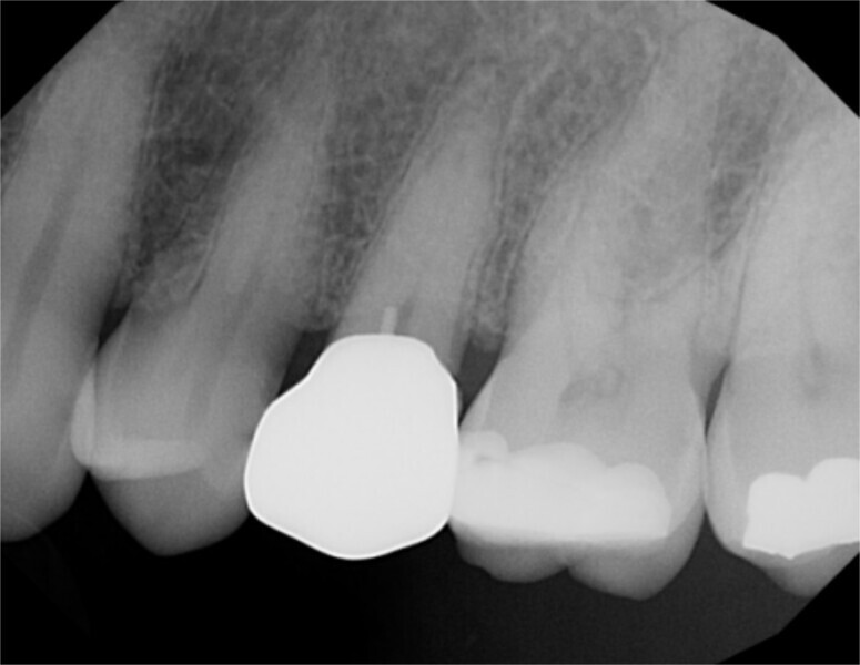 Fig. 17: Periapical radiograph four weeks after laser treatment and restoration of the tooth, demonstrating a lack of periapical pathology since treatment had been completed.