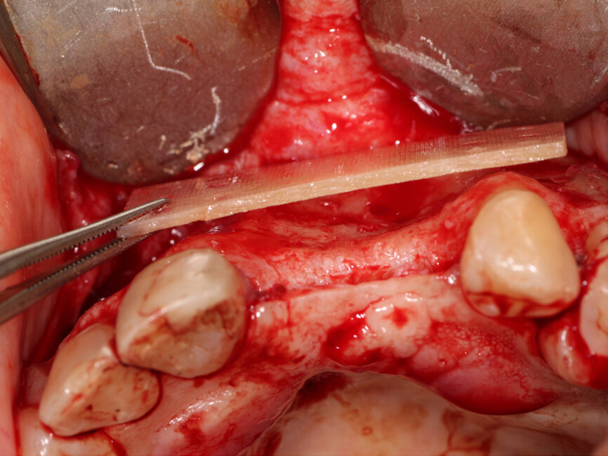 Fig. 9: A 15-by-30-mm piece of Flexo-Plate Plus (Osteolife Biomedical, Jupiter, Fla.) will be placed as the new facial extend of the ridge to contain the graft and act as a mold for the desired ridge augmentation. 