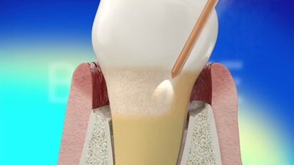 BIOLASE REPAIR Perio protocol shows superior results in study