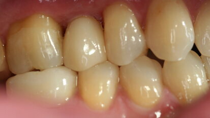 Implants en zircone : remplacement entièrement sans métal d’une deuxième prémolaire maxillaire