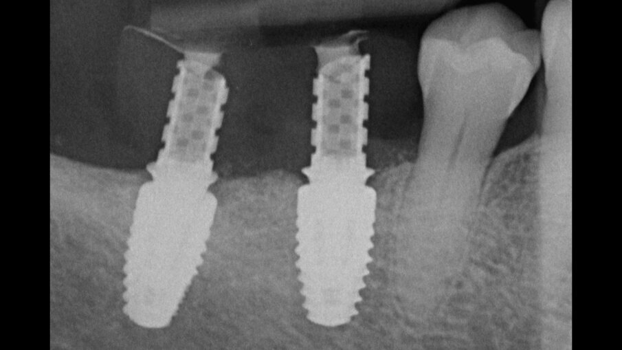 Figg. 12a, 12b_Immagine clinica e radiografica che mostrano il manufatto protesico provvisorio.