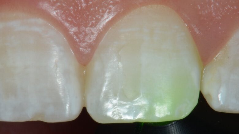 Foto 2. Diente 21, donde se observa el comportamiento de las manchas blancas cuando colocamos el lente de la transiluminación (Valo).
