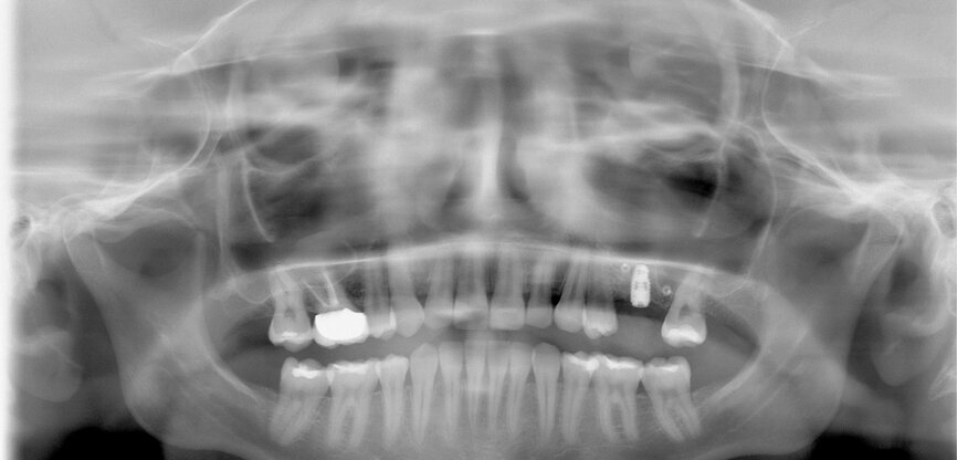 Fig. 15: Implant fixed with pins.