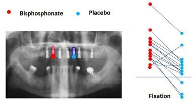 Un nouveau revêtement accélère la fixation des implants dentaires