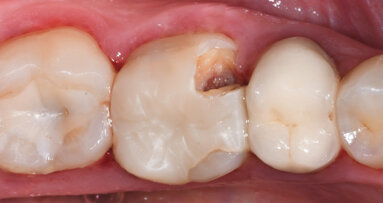 A single-visit digital workflow for endodontic treatment and restoration