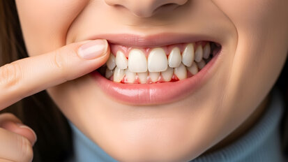 Gum Health Day: Bewusstsein für Zahnfleischgesundheit schaffen