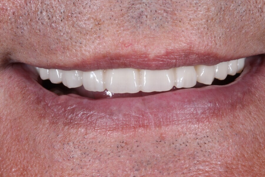 Fig. 17: The nal prosthesis on the day of delivery.