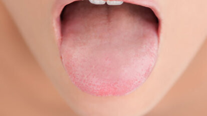 Η ξηροστομία αντικείμενο συζήτησης στο φόρουμ υγιεινής της Μεγάλης Βρετανίας