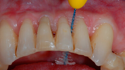 Nuovo spazzolino interdentale con disegno anatomico per la detersione degli spazi interprossimali