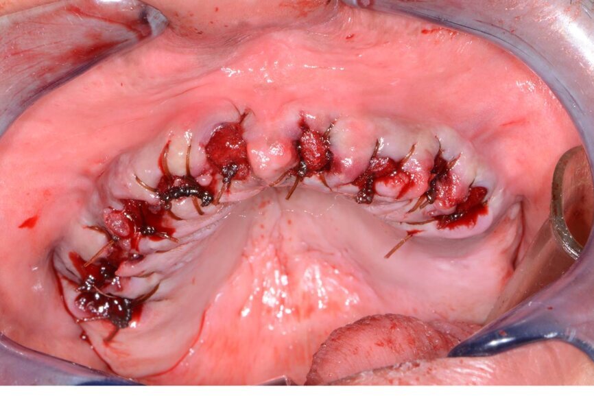 Fig. 7: Area grafted and sutured.