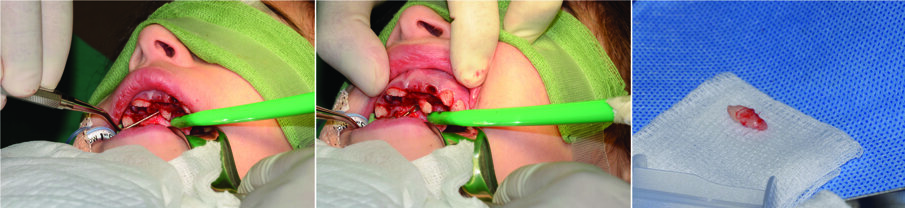 Figs. 8. (a, b & c) show sequence of careful elevation of the supernumerary ($) tooth.