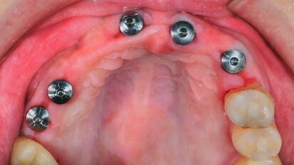 Predictable longevity of dental implants: high-quality evidence support