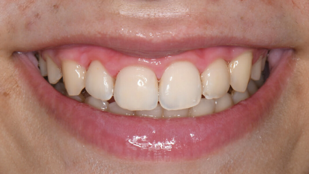 Figg. 7, 8 - Risultato finale del sorriso post-trattamento.