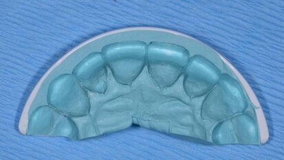 Improving success with your cosmetic cases using the TMJ QuickSplint