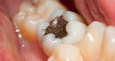 EU-endorsed dental amalgam reduction enters into effect