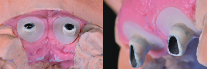 Figs. 19–20 : Élaboration des piliers provisoires avec un profil d’émergence naturel pour assurer le soutien de la gencive. 