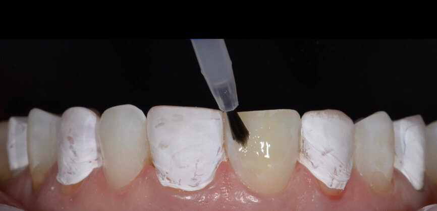 Fig. 8: Each tooth was gently air-dried for 10 seconds. CLEARFIL Universal Bond Quick was applied with a rubbing motion without additional waiting time, followed by drying of the treated surfaces by gentle blowing of air for more than 5 seconds until the bonding no longer moved. 