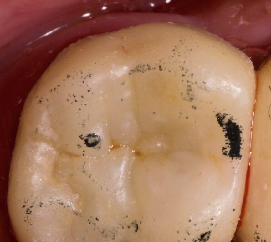 Fig. 17 : Contrôle de l’occlusion. 