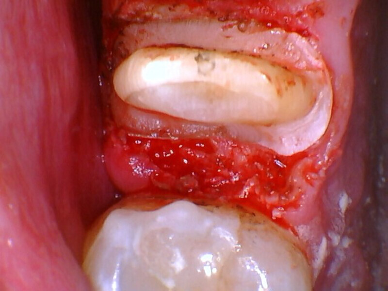 Fig. 8: Completed crown preparation and the core over the mesial aspect protecting the pulpal exposure.