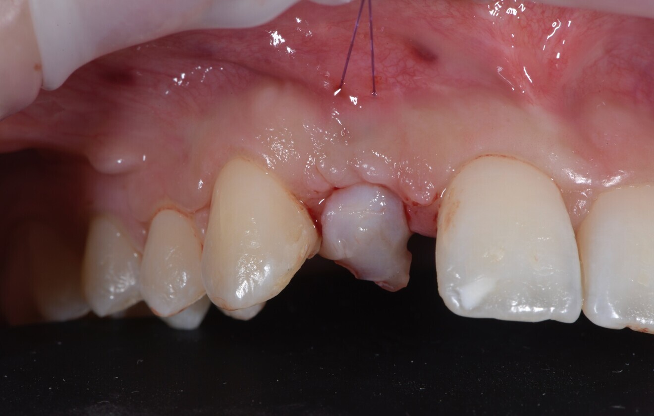 Fig. 6: Connective tissue graft from the palate sutured to thicken the peri-implant mucosa after implant placement.