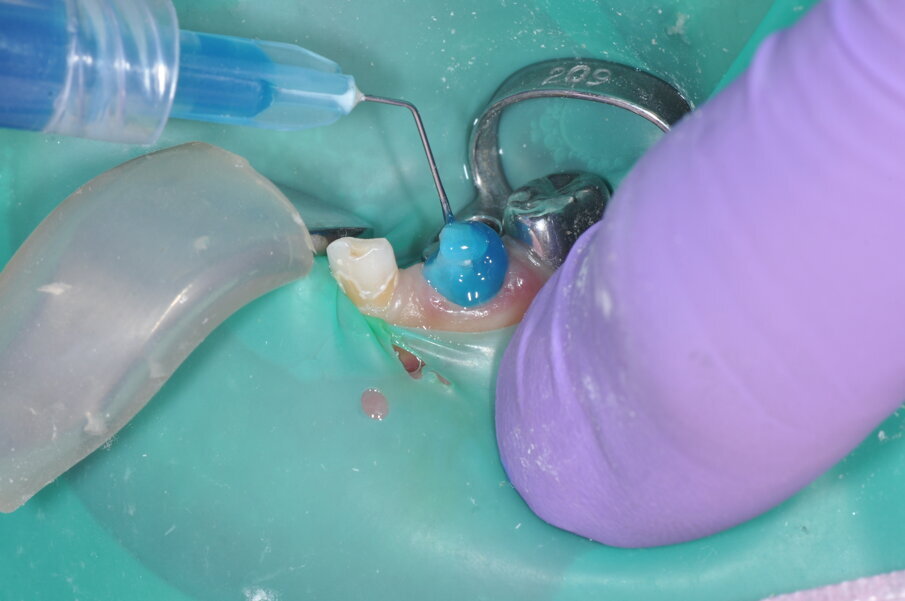 Fig. 6: Tooth surfaces prepared with 37% phosphoric acid for 10 seconds.