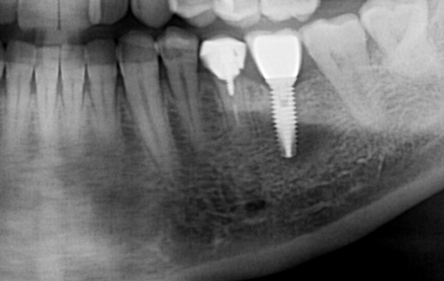 Fig. 1a: Initial situation: apical radiograph (a), intra-oral view (b) and CT scan (c).