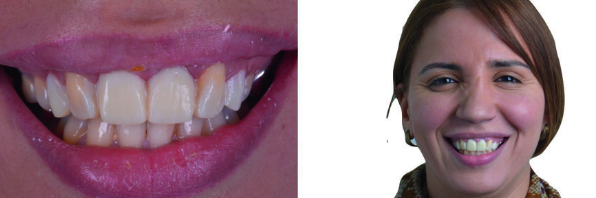 Fig. 11: Mock-up intra-oral. 