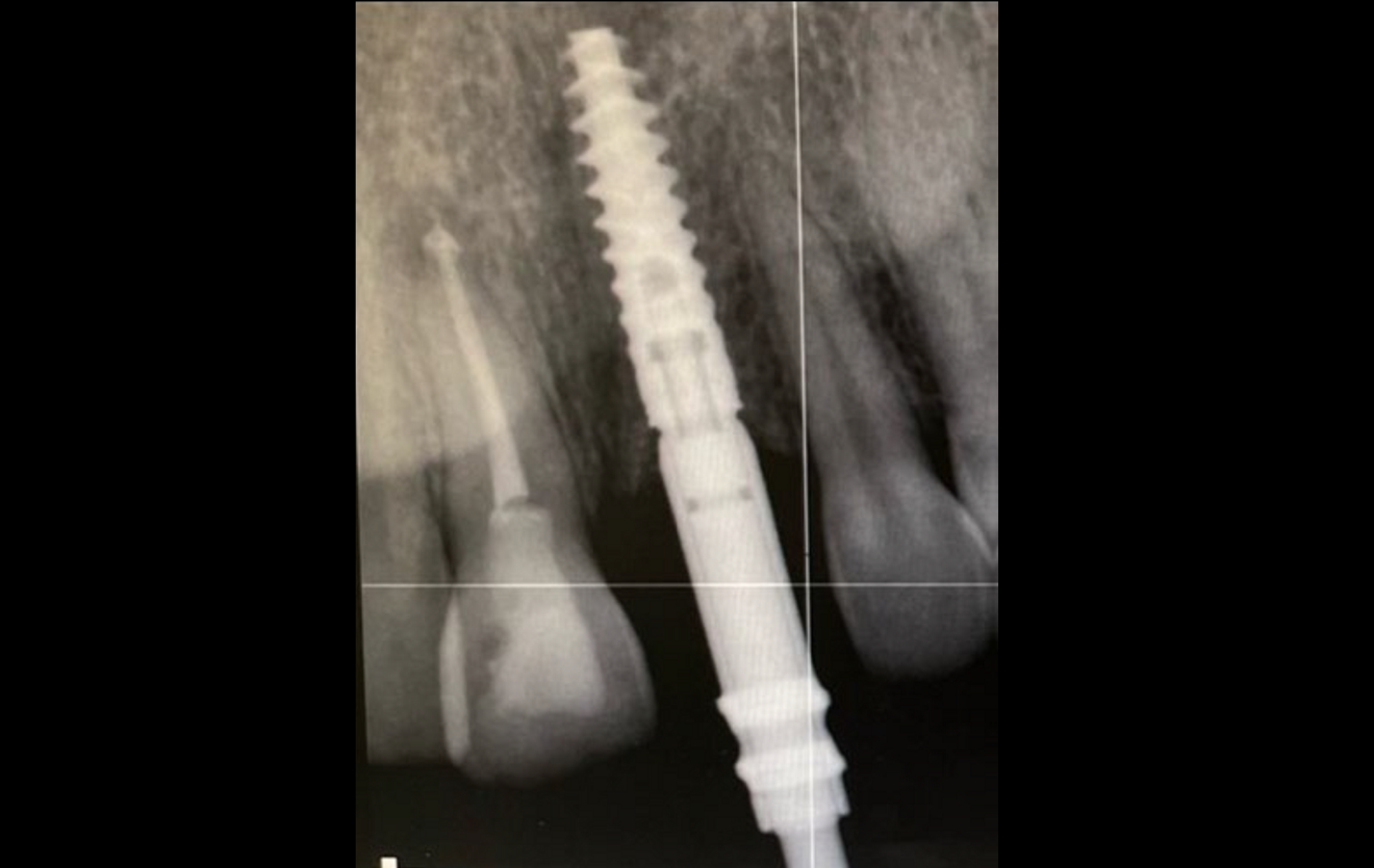 Figs. 2a–h: Demonstration of the study results through the case of a non-smoking 34-year-old female patient with a missing maxillary central incisor. Radiograph (a)...