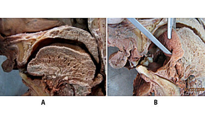 Anquiloglosia-Frenillo lingual-Frenotomía. (Parte I) Diagnóstico