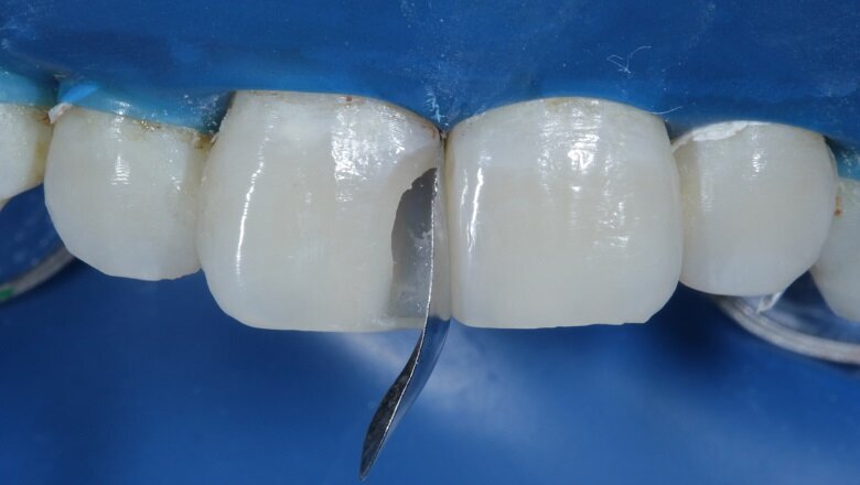 Fig 13: Band Placed (Sectional Matrix) 