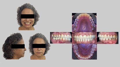El dispositivo infalible para evitar el ronquido y la apnea de sueño