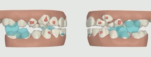 ClinCheck® set-up of aligner stage #1, with mandibular advancement features (precision wings) in blue.