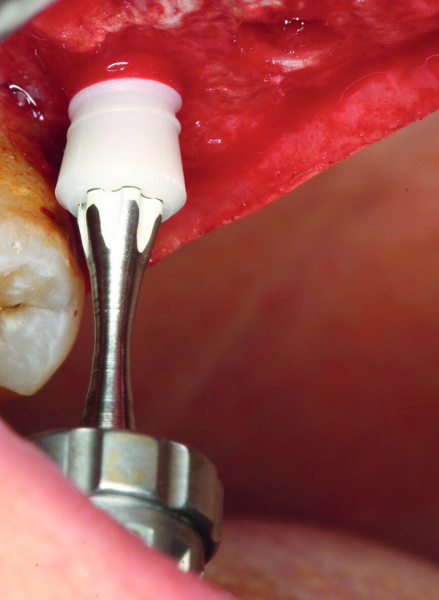 Fig. 13 : Insertion de l’implant dans la région dentaire 17. 