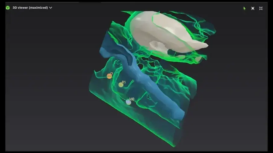  Фиг. 15 3D реконструкция, показваща, че нервът е заобиколил букалната област и е засегнал само средната част на медиалния канал.