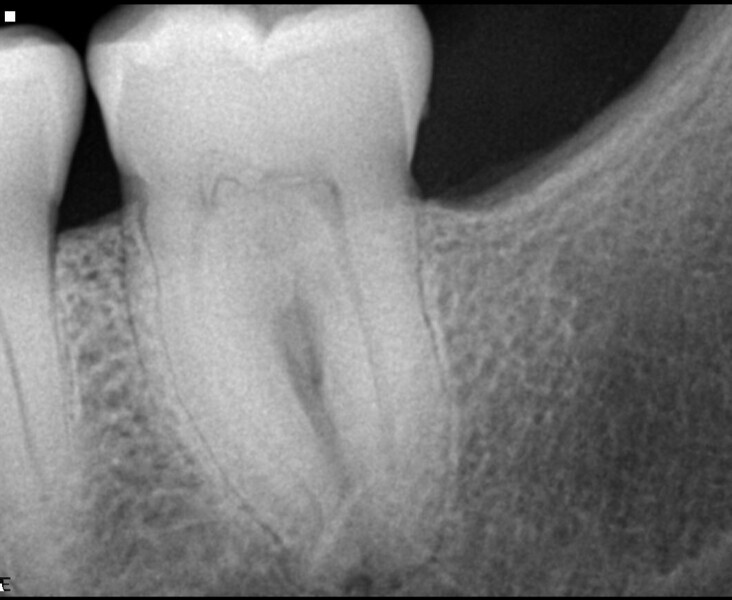 Fig. 8a: Pre-op radiograph showing the calcified pulp chamber and radiolucency in the furcation area (a). The fistula facing the coronal part of the root canal (b).