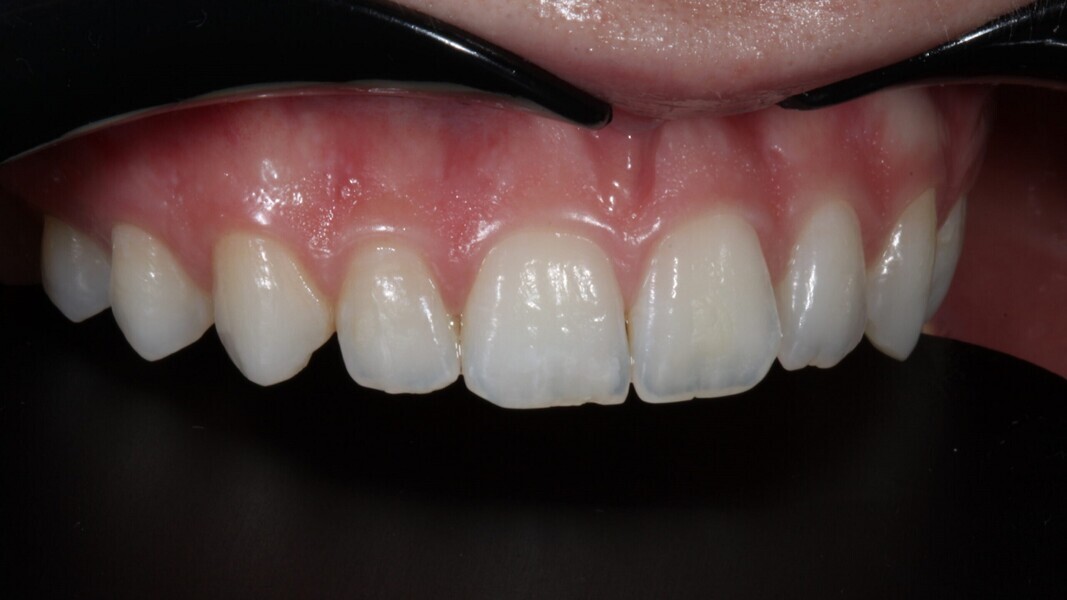 Fig. 3: Buccaal aanzicht. Anatomie van tand #12.